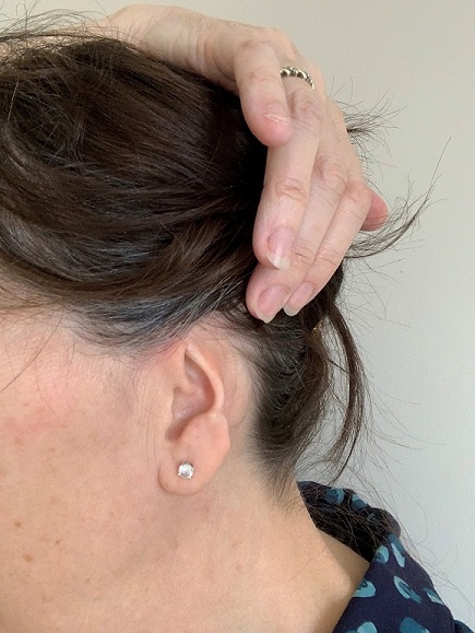 Tina's ear left with scarring from skin cancer